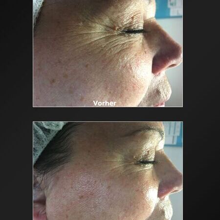 ProCeA | Vorher-Nachher