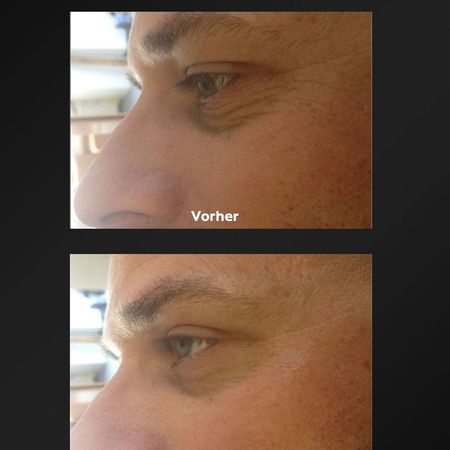 ProCeA | Vorher-Nachher