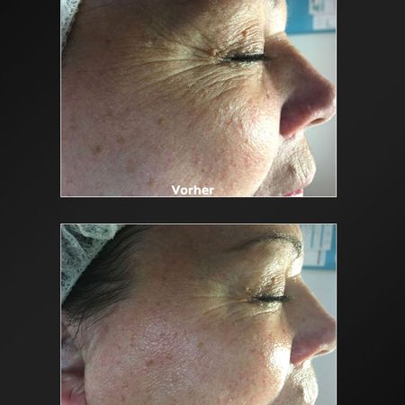 ProCeA | Vorher-Nachher