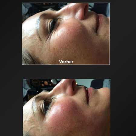 ProCeA | Vorher-Nachher